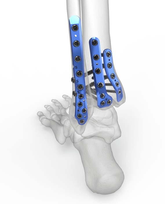 Trimalleolaarimurtumassa distaali fibula ja distaali tibia voidaan levyttää käyttämällä posteriorista avausta.