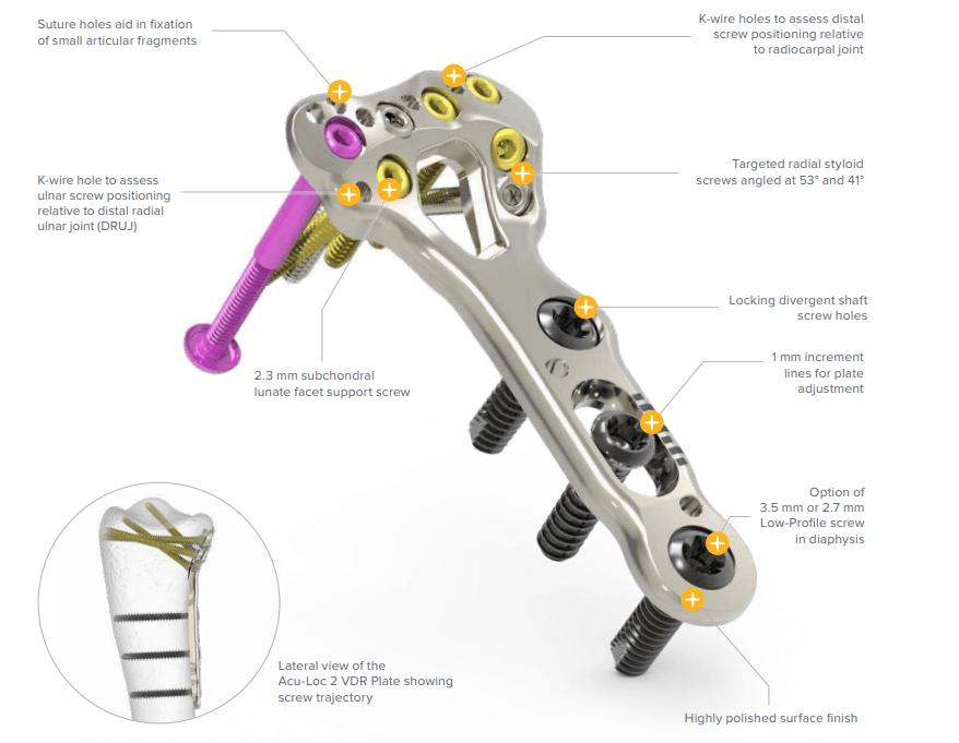 Distal radius fracture: operative treatment - Rannemurtuma on yleinen murtuma Suomessa. Acumedin Aculoc portfolio tarjoaa laajan valikoiman instrumentteja värttinäluun alaosan murtuman hoitoon.